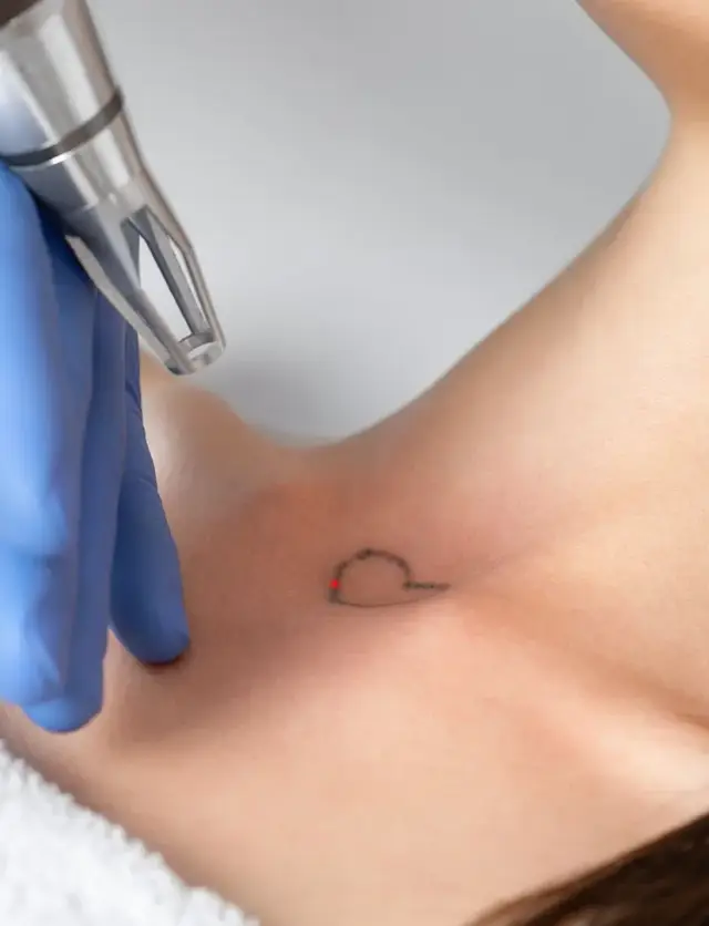 tattoo0entfernung-kanton-zürich